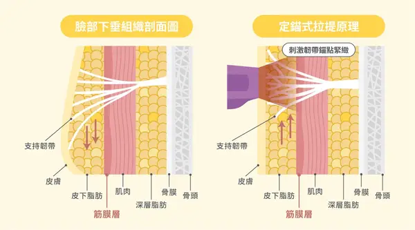 黃金電波拉皮 法令紋淡化 